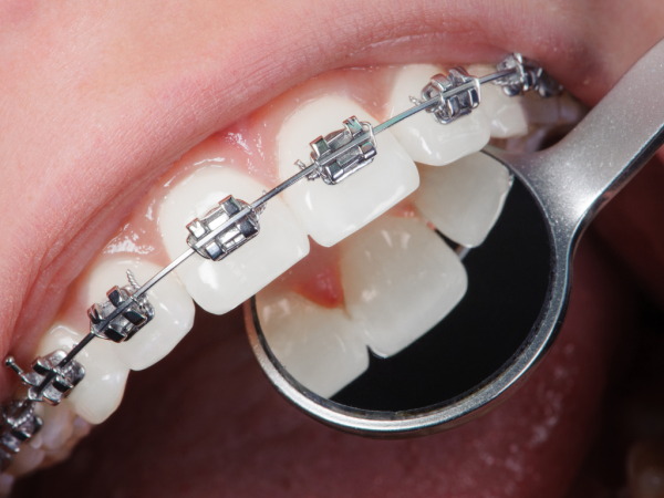 Radiant Smiles Dental Care Provides Advanced Damon Clear Braces for Patients in Perth