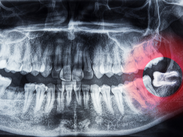 Totalcare Dental and Dermal Announces Enhanced Wisdom Teeth Removal Services for Sydney Patients