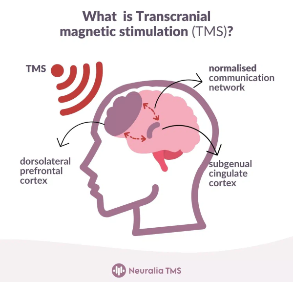 Neuralia TMS Delivers Advanced TMS Therapy Services in Melbourne