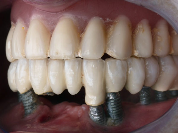 Radiant Smiles Dental Care Provides Leading All On 4 Dental Implant Solutions in Albany