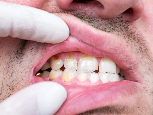 Brisbane Paediatric Dentist Provides Targeted Care for Enamel Hypoplasia