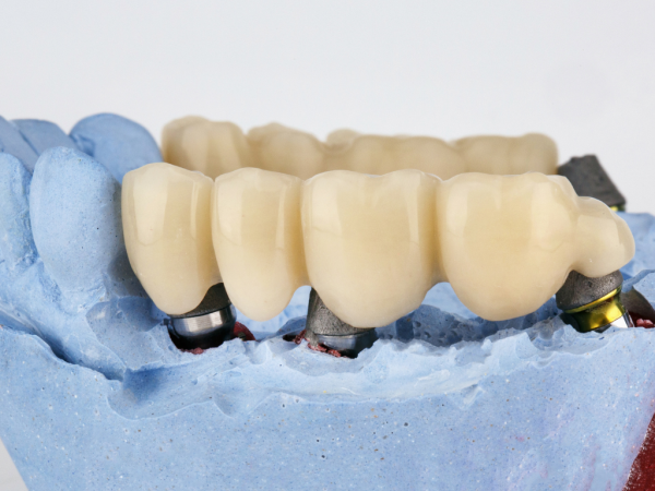 Radiant Smiles Dental Care Enhances Dental Bridge Options for Restorative Patients