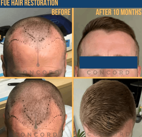 Concord Hair Restoration Announces Invisible Aesthetics Protocol for High-Definition 8K Cinematography Standards