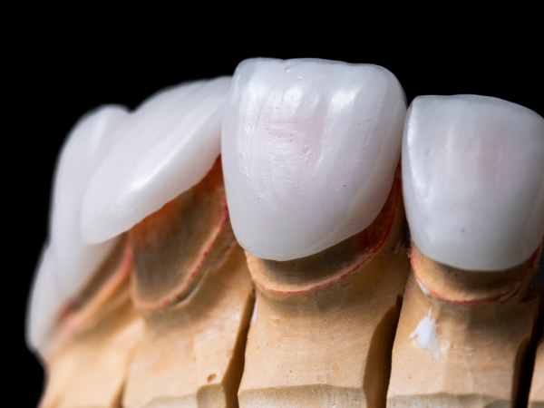 Radiant Smiles Dental Care Elevates Cosmetic Dentistry with Premium Veneers in Perth