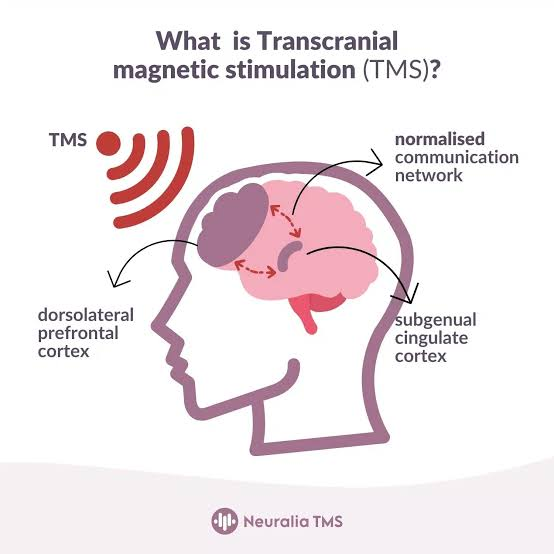 Neuralia TMS Spotlights TMS Therapy Availability at Its Kardinya Location