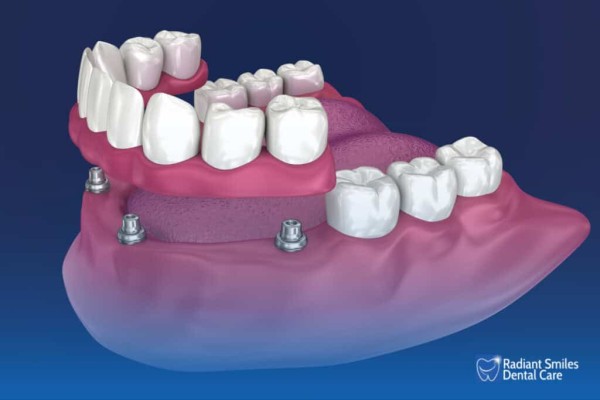 Radiant Smiles Dental Care Provides All-on-4 Dental Implants in Perth